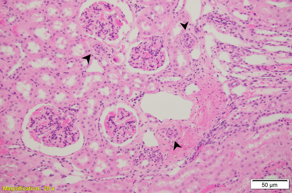 histopathology showing renal hypertensive vasculopathy